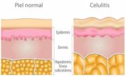 diatermia celulitis