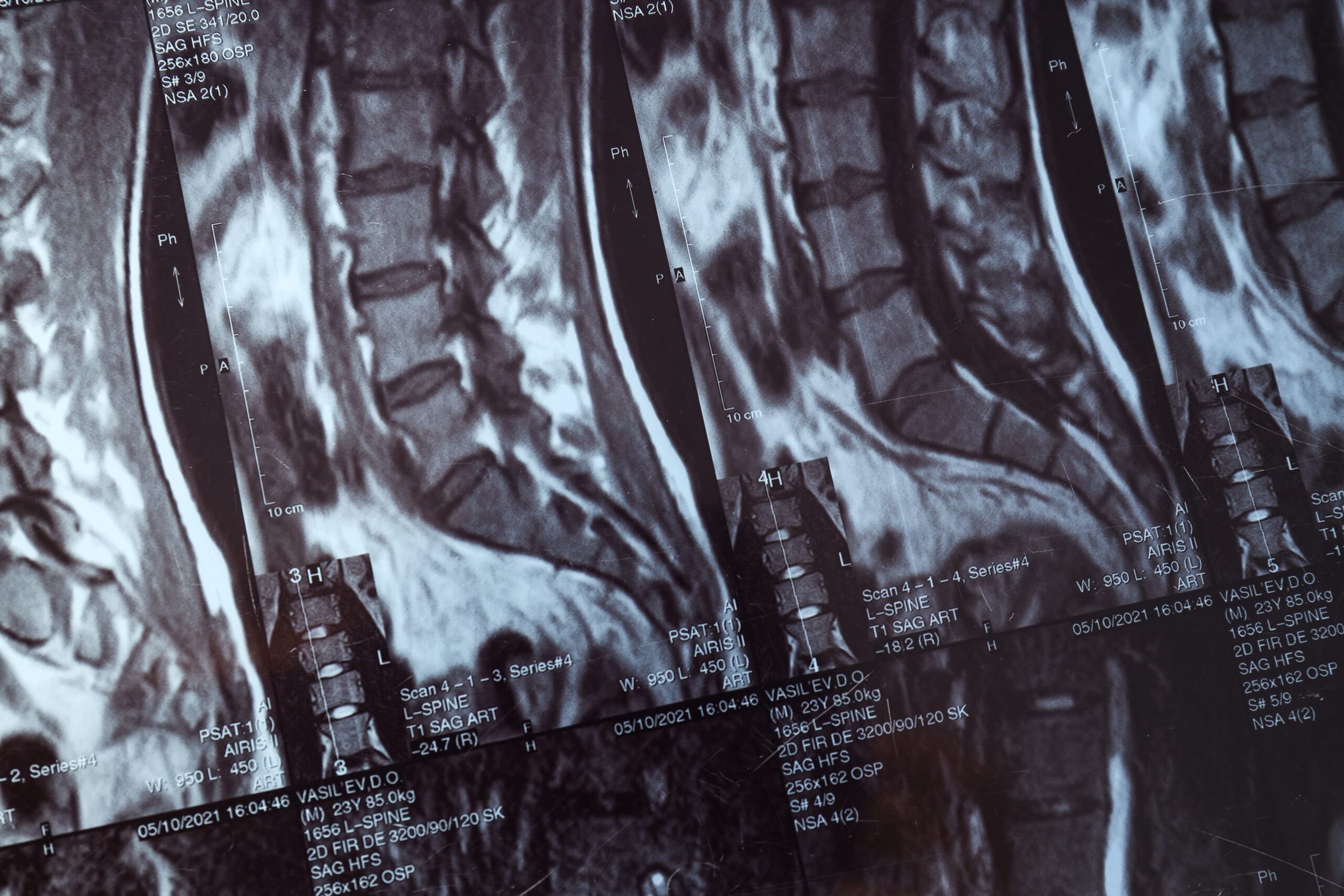 Hernia discal cervical 1 hernia discal cervical scaled