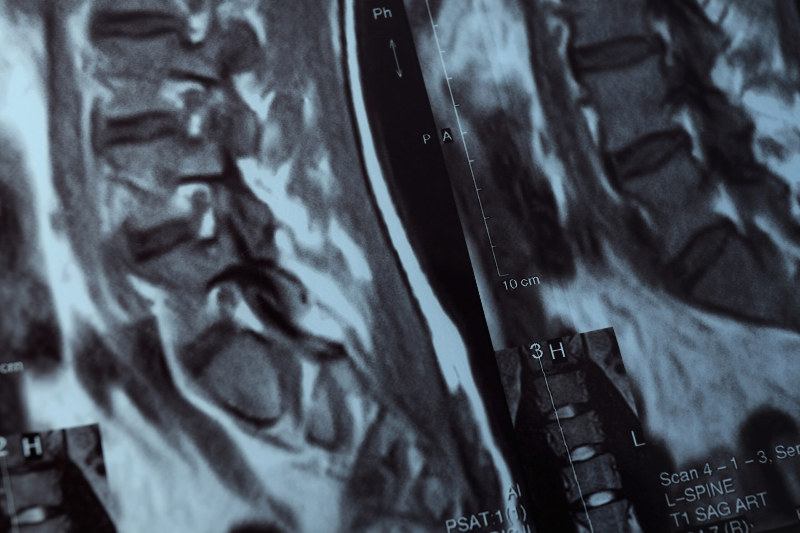 Hernia discal lumbar 1 Hernia discal lumbar
